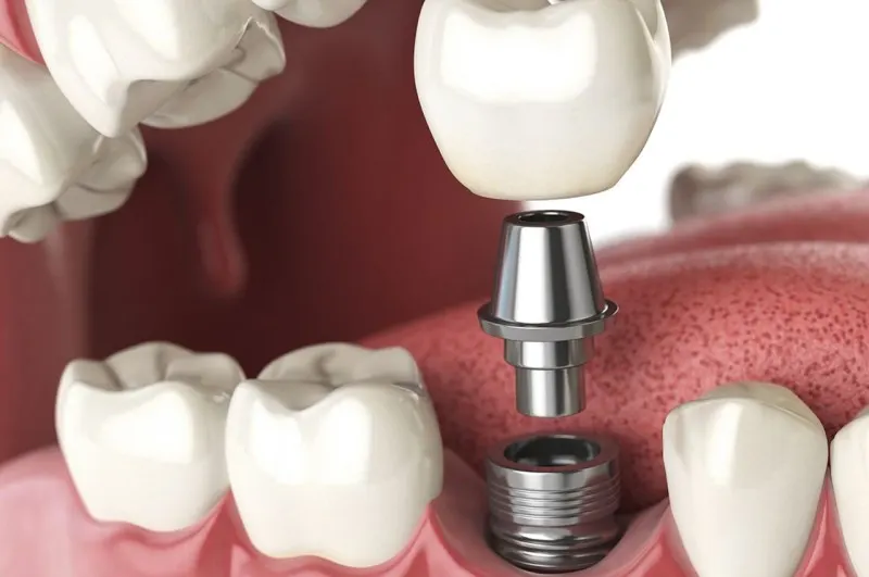 Imagen ilustrativa de un implante dental y una corona entre los dientes.